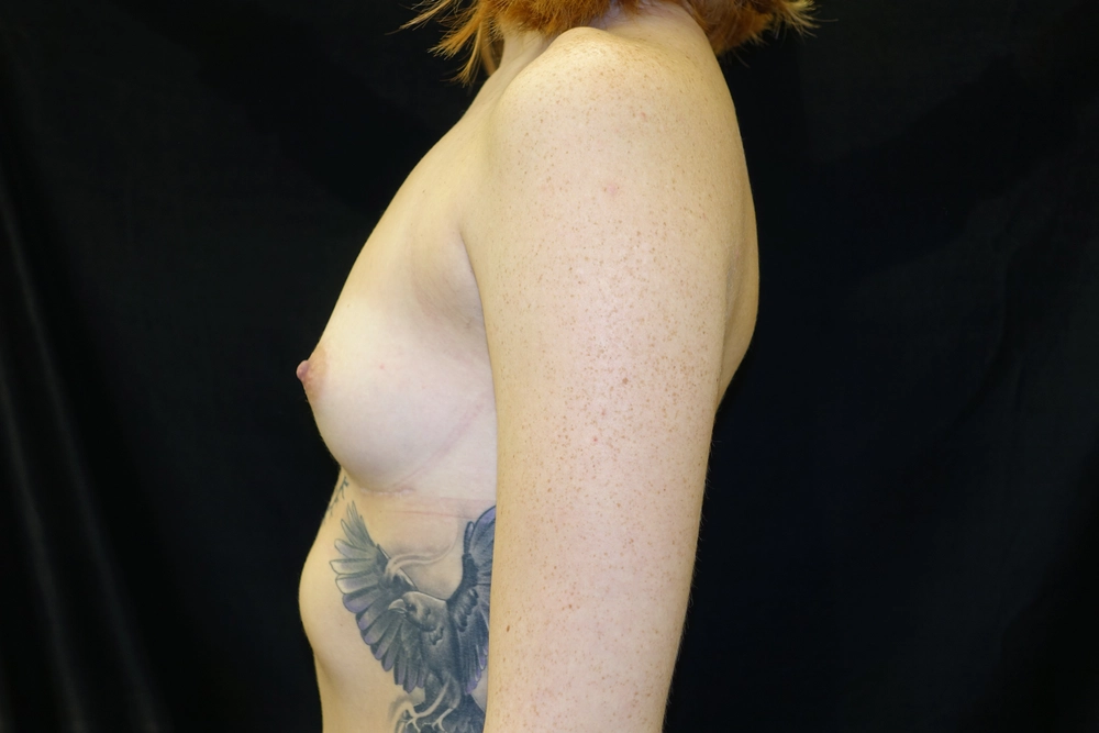 breast-augmentation Before Photo for Patient #12