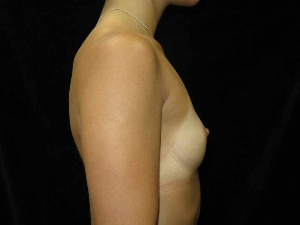 breast-augmentation Before Photo for Patient #13