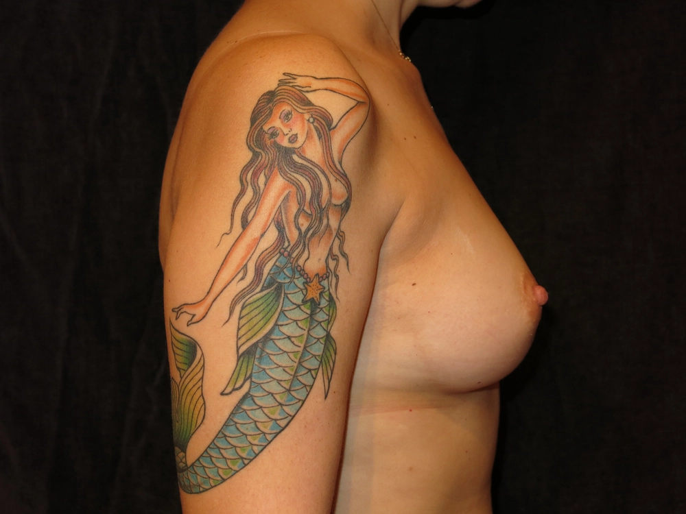 breast-augmentation Before Photo for Patient #19