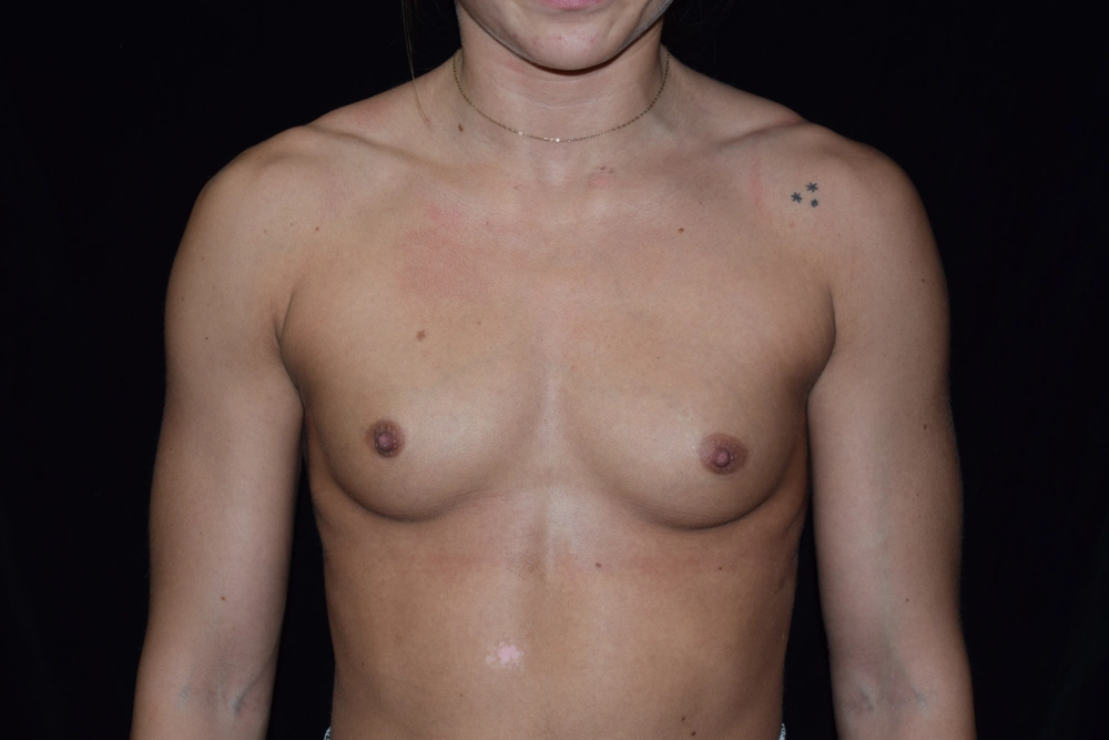 breast-augmentation Before Photo for Patient #23