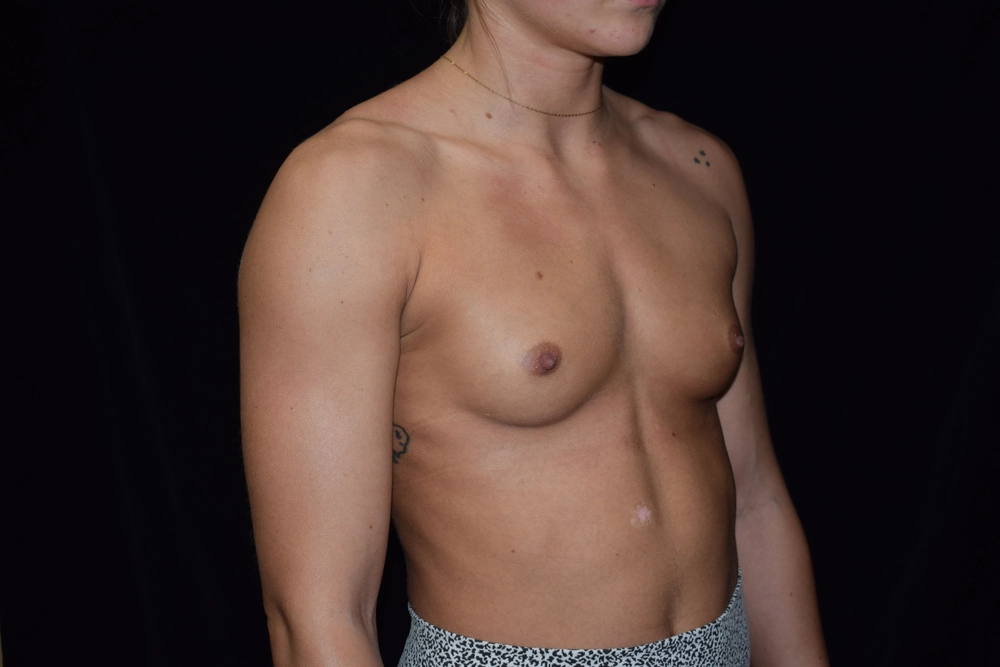 breast-augmentation Before Photo for Patient #23