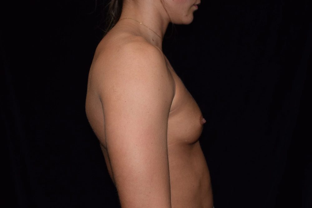 breast-augmentation Before Photo for Patient #23