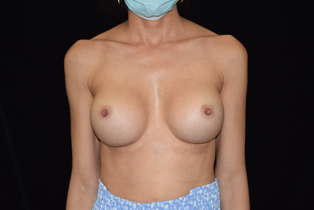 breast-augmentation After Photo for Patient #26