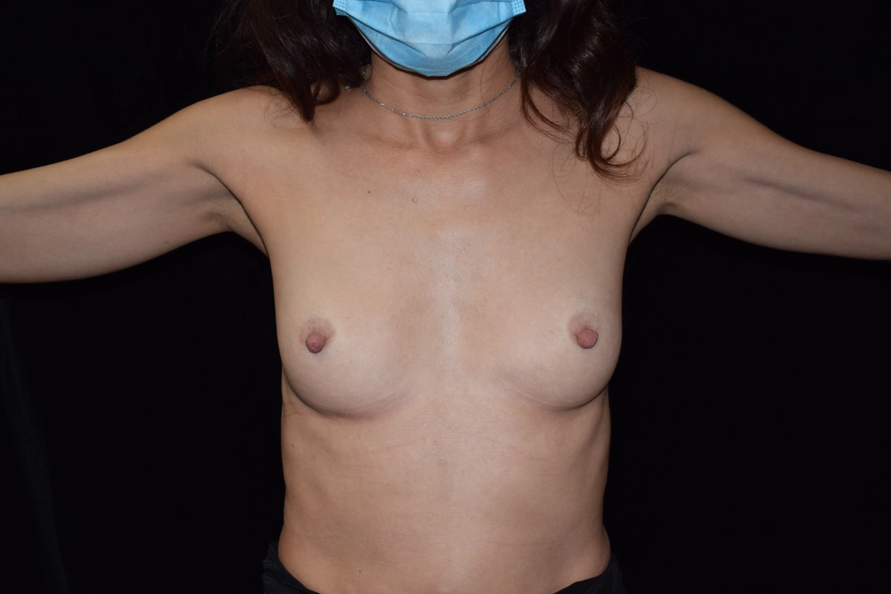 breast-augmentation Before Photo for Patient #26