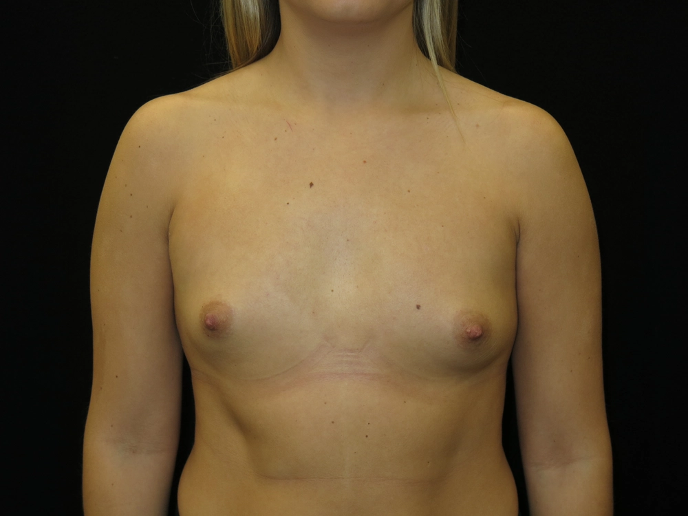 breast-augmentation Before Photo for Patient #36