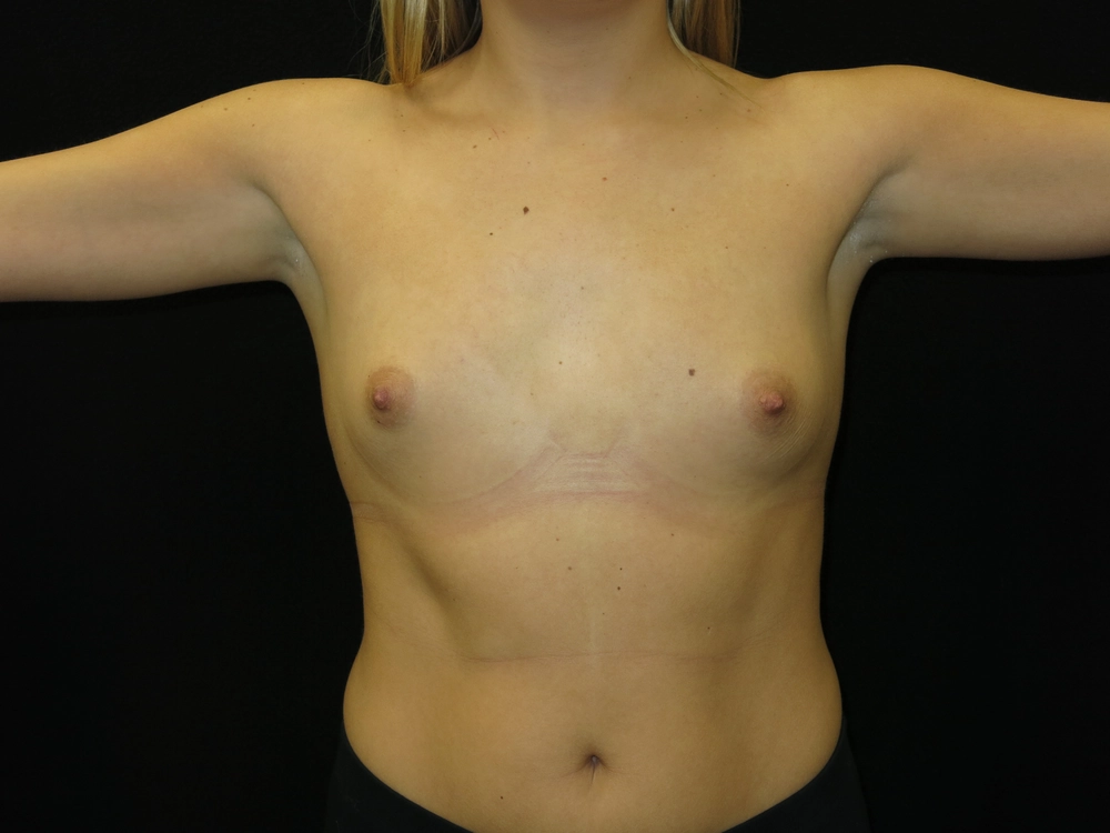 breast-augmentation Before Photo for Patient #36