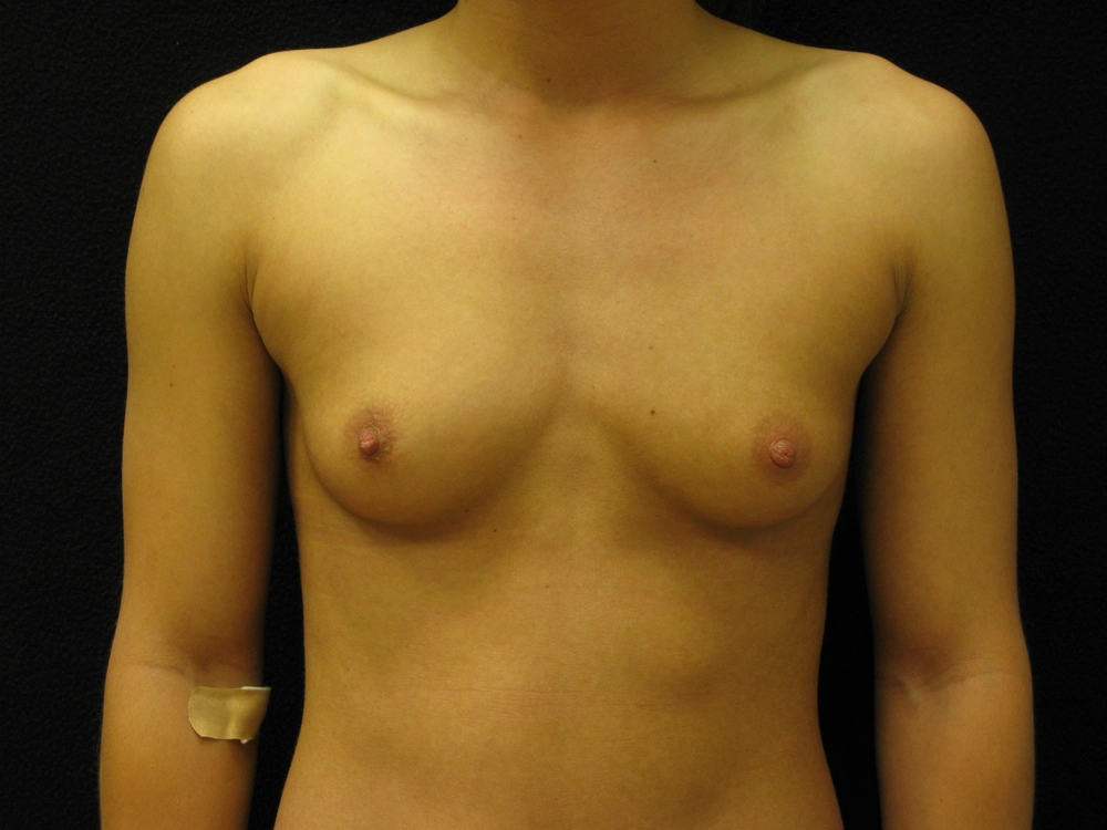 breast-augmentation Before Photo for Patient #9