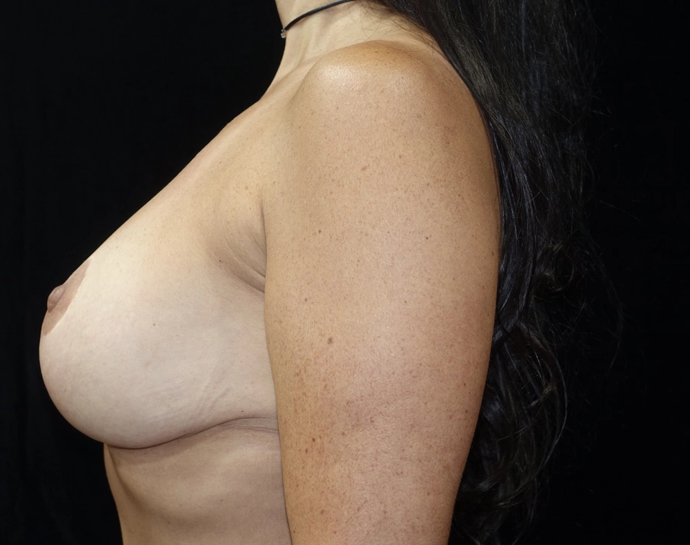 breast-lift After Photo for Patient #5