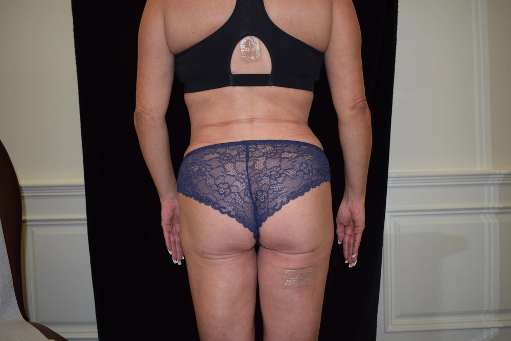 liposuction After Photo for Patient #10