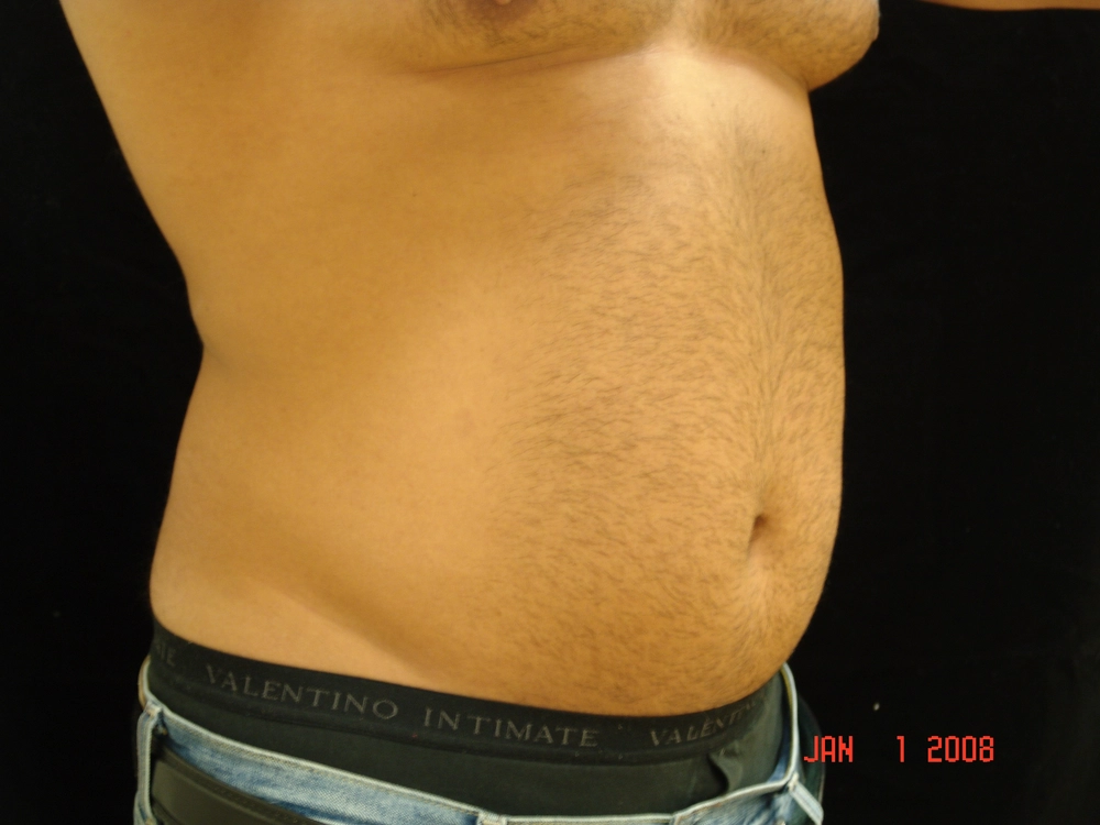 liposuction Before Photo for Patient #1