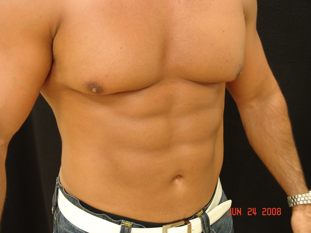 liposuction After Photo for Patient #1