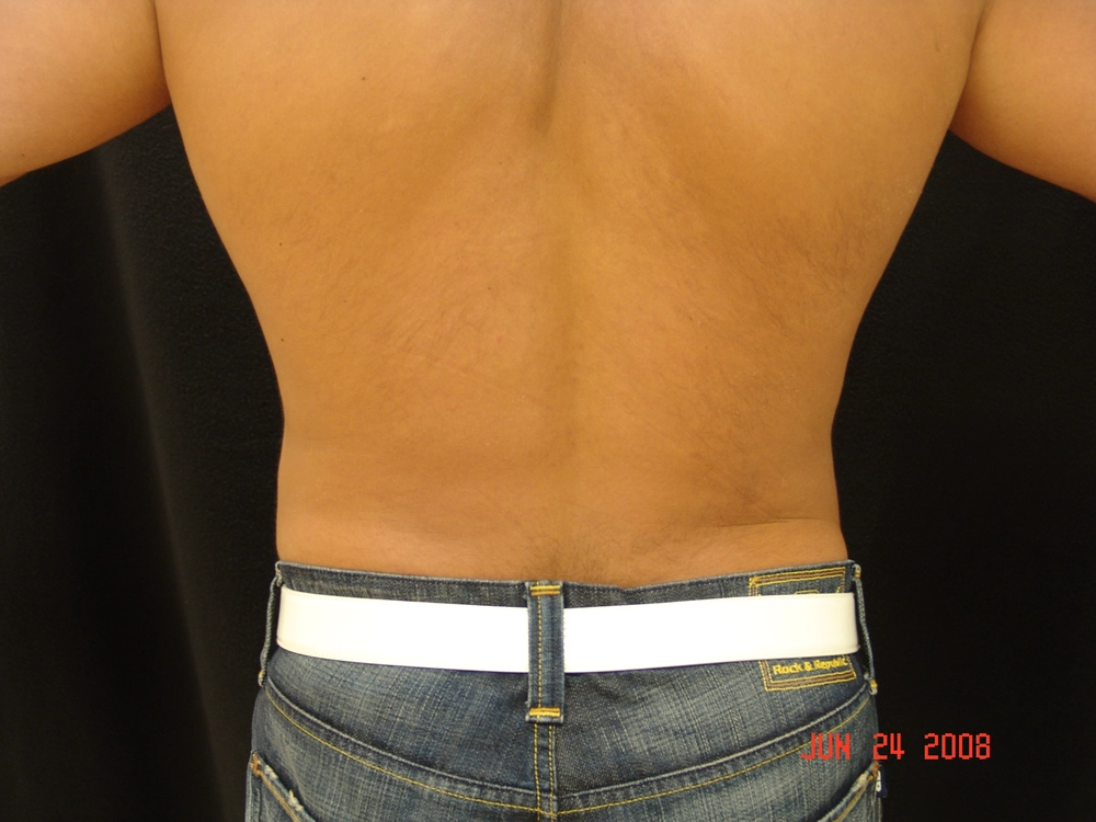 liposuction After Photo for Patient #1