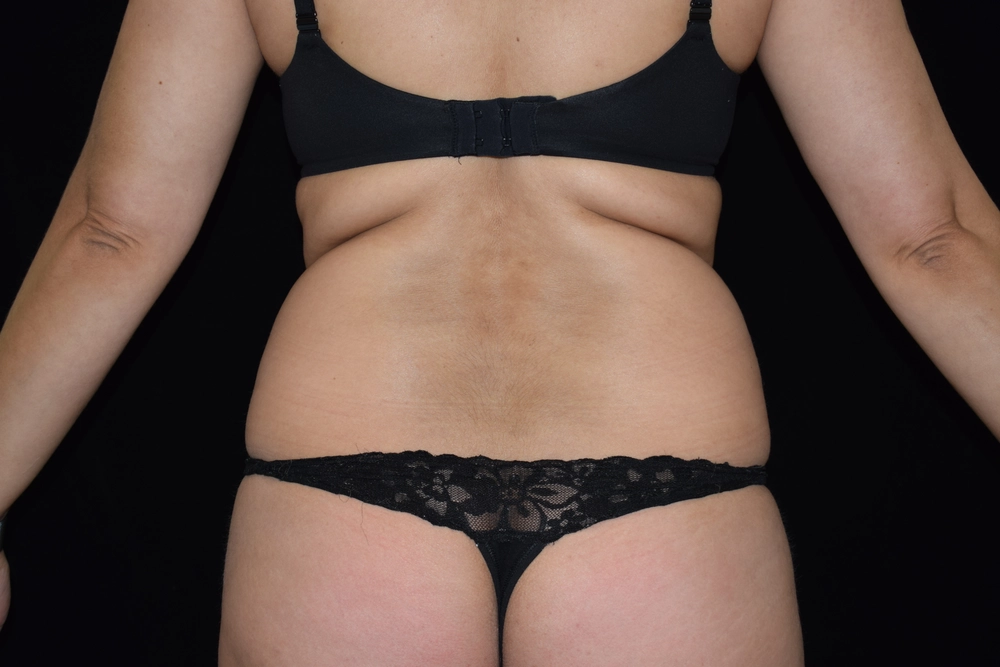 liposuction Before Photo for Patient #14