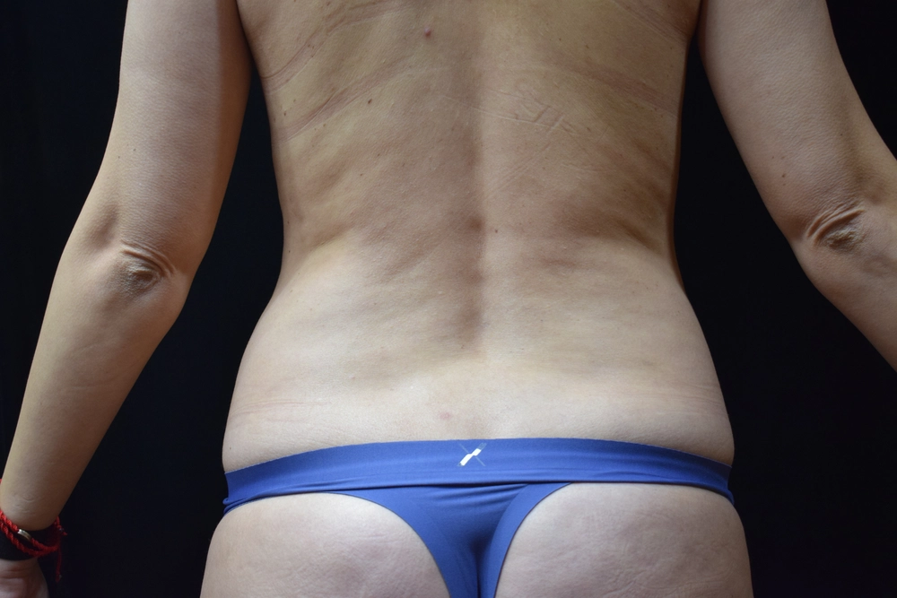 liposuction Before Photo for Patient #16