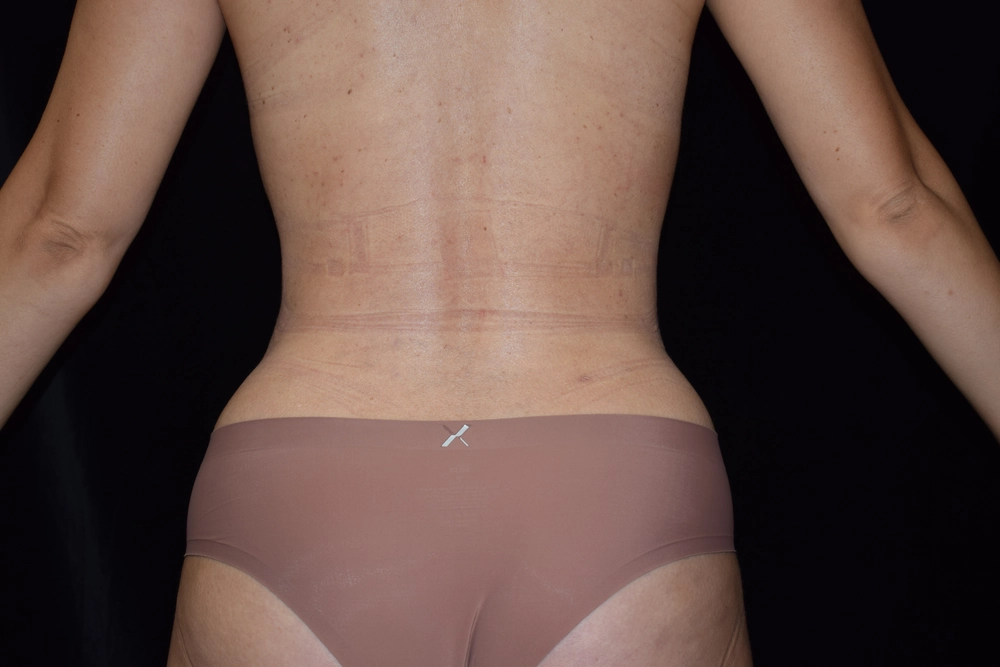 liposuction After Photo for Patient #16