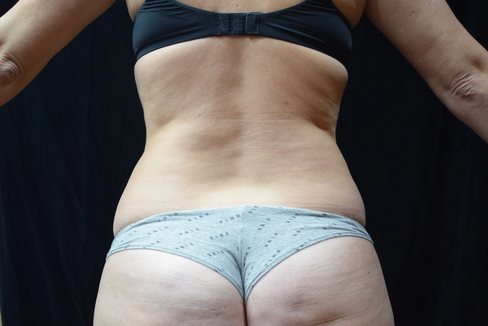 liposuction Before Photo for Patient #17