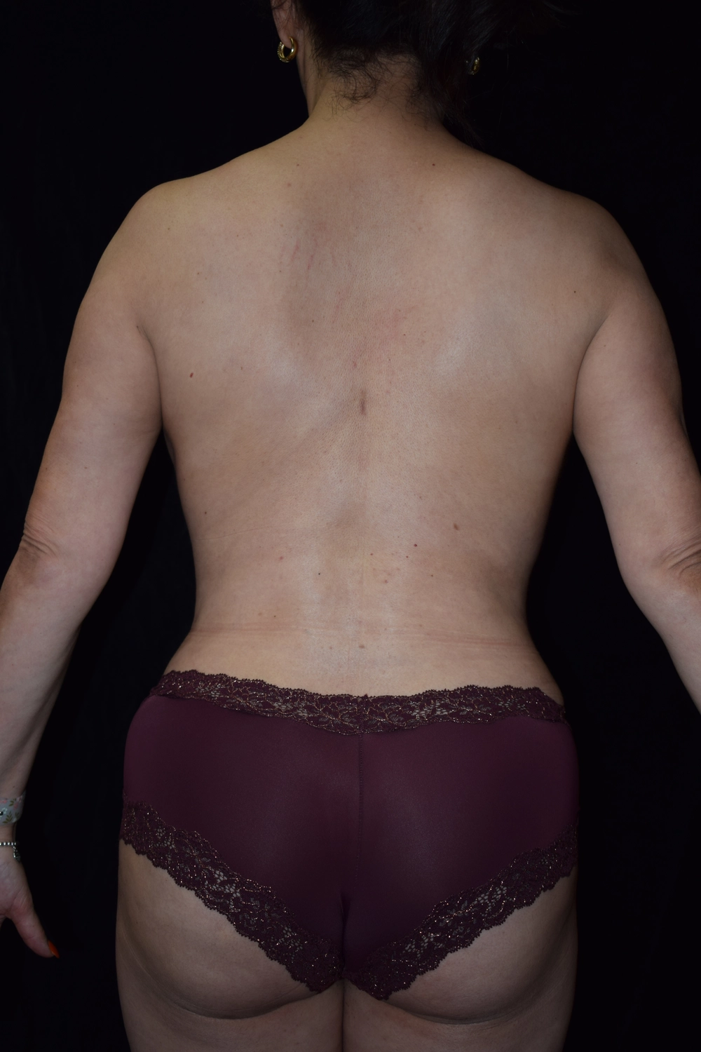 liposuction After Photo for Patient #19