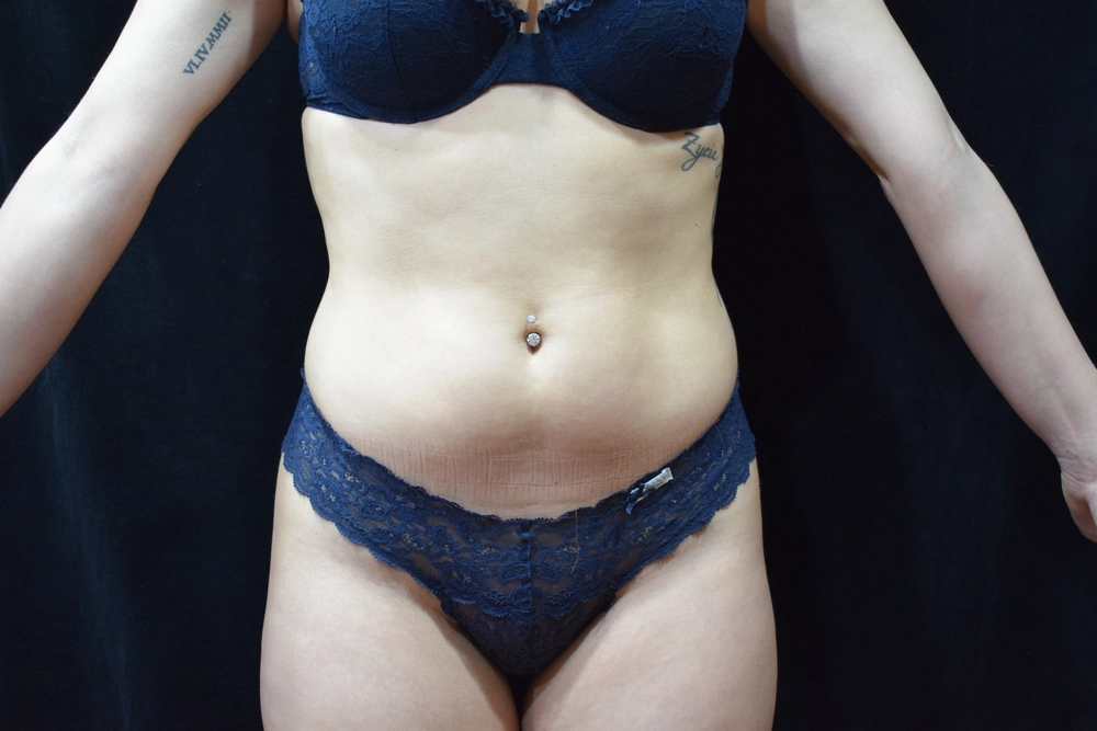 liposuction Before Photo for Patient #3