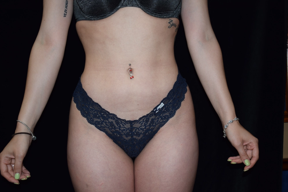 liposuction After Photo for Patient #3