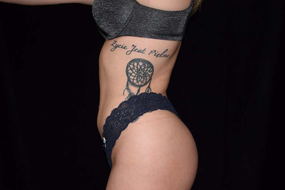 liposuction After Photo for Patient #3