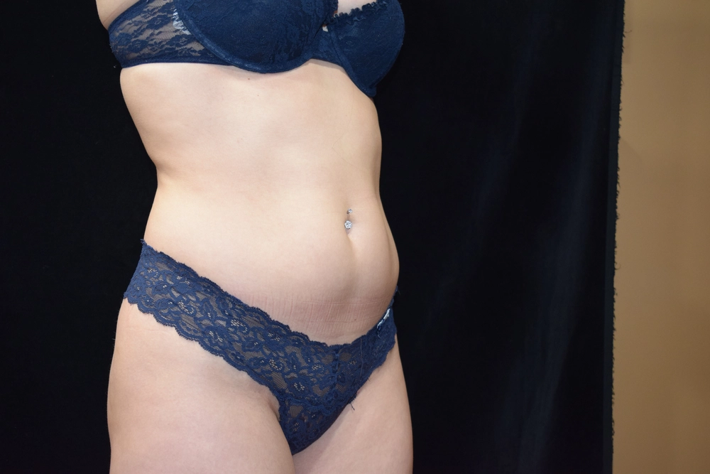 liposuction Before Photo for Patient #3