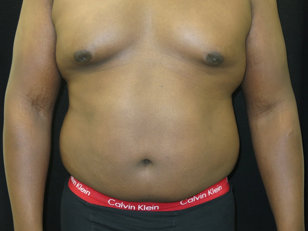 liposuction Before Photo for Patient #5