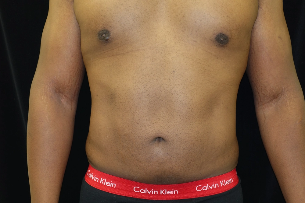 liposuction After Photo for Patient #5