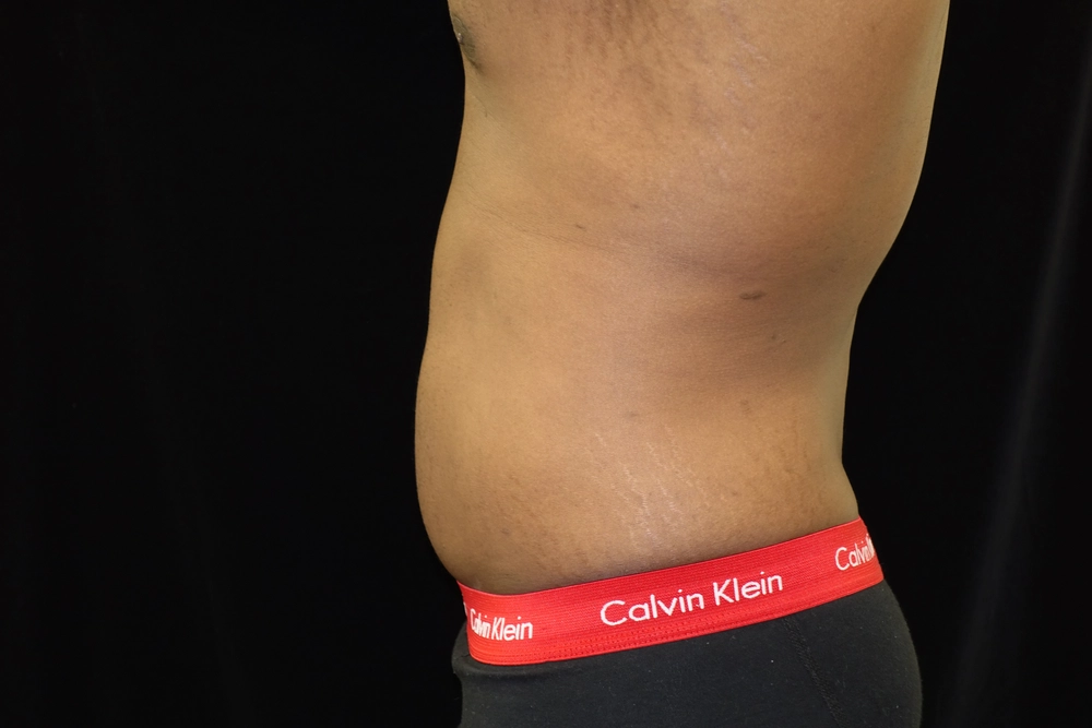 liposuction After Photo for Patient #5