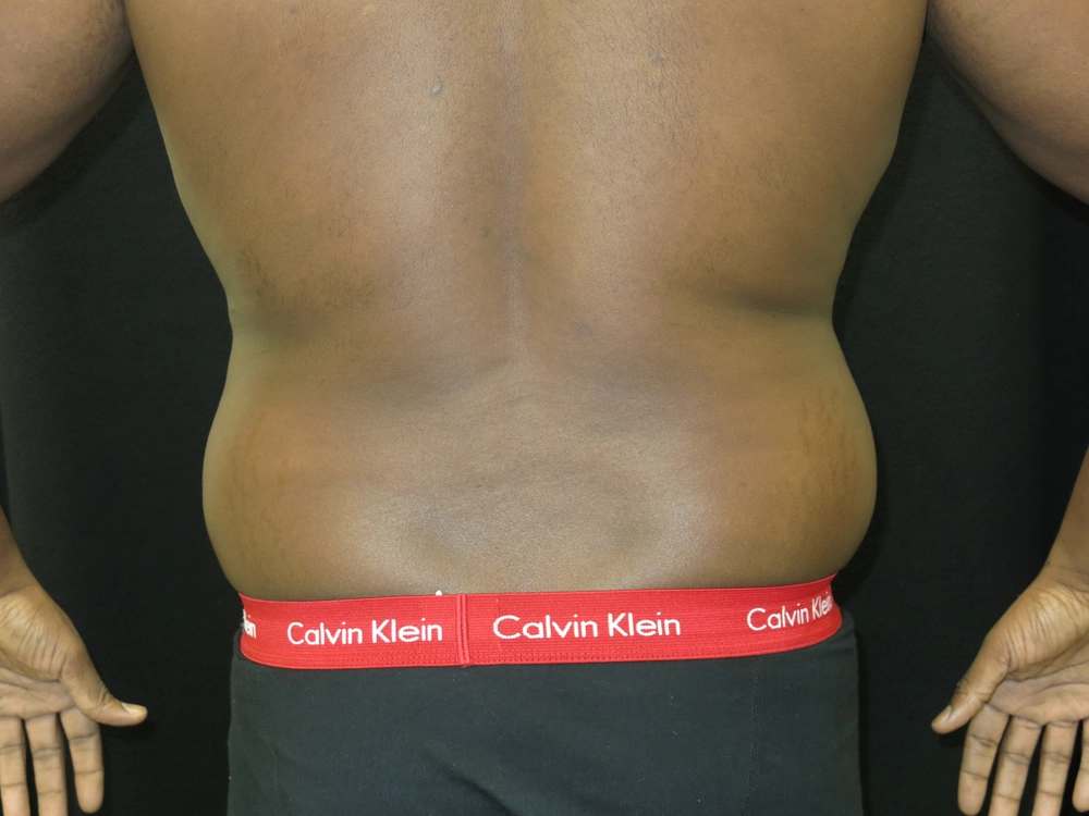 liposuction Before Photo for Patient #5