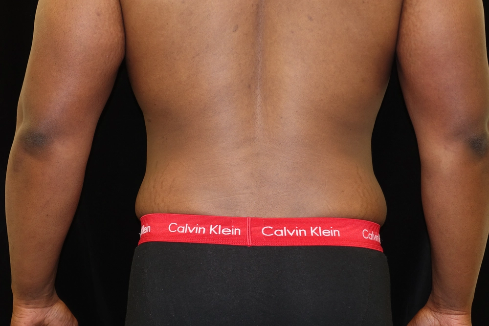 liposuction After Photo for Patient #5