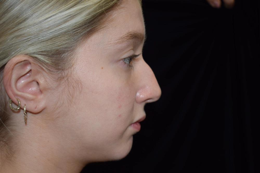 rhinoplasty Before Photo for Patient #1