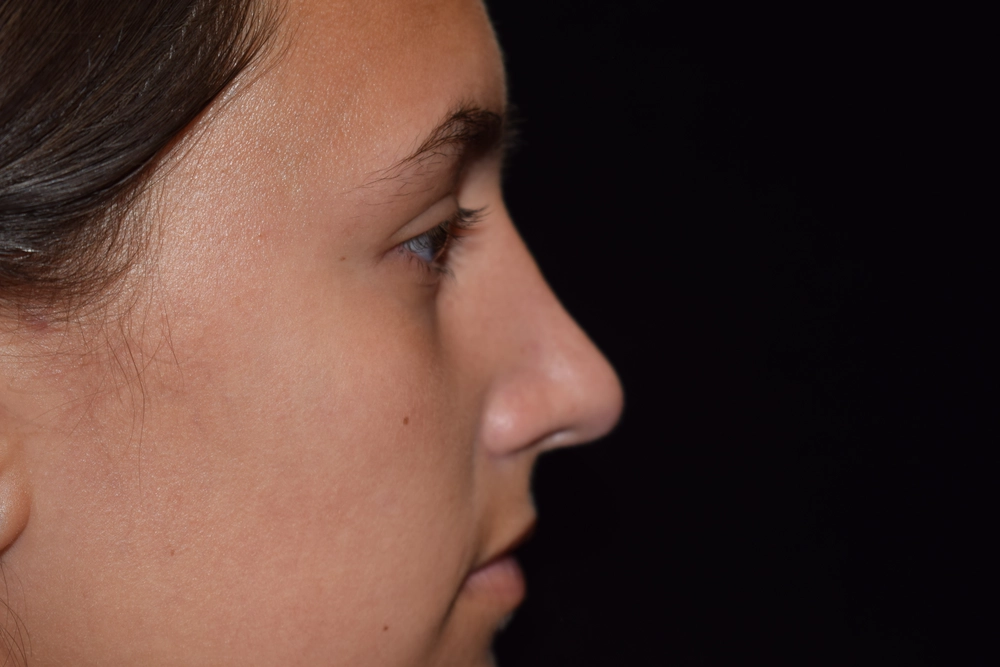 rhinoplasty After Photo for Patient #2
