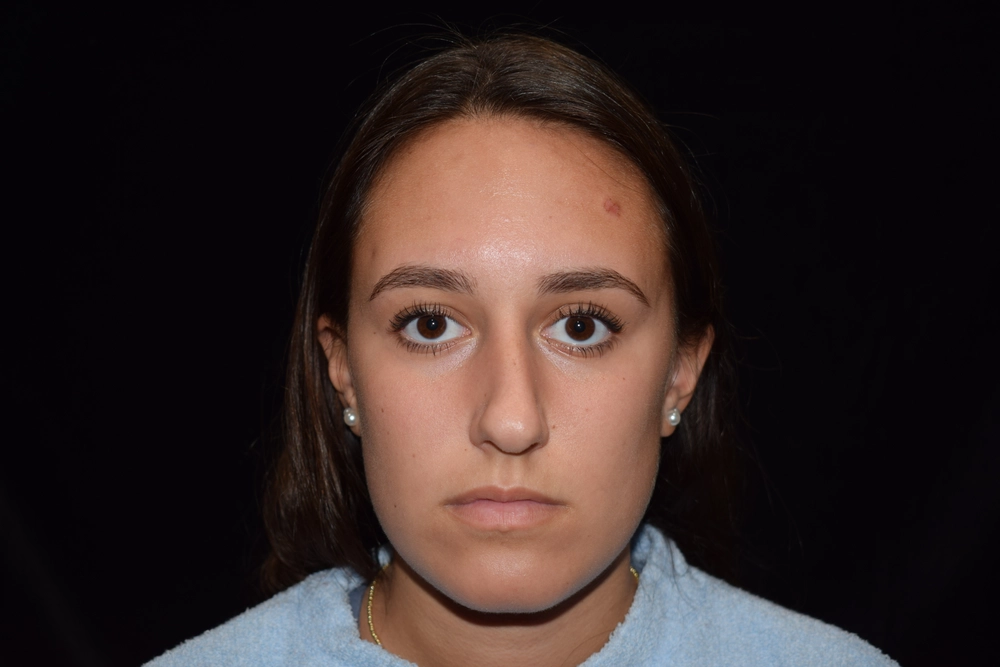 rhinoplasty Before Photo for Patient #2