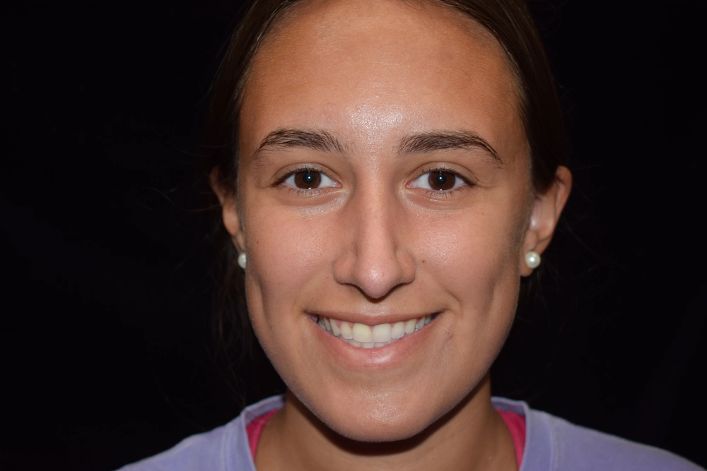 rhinoplasty After Photo for Patient #2