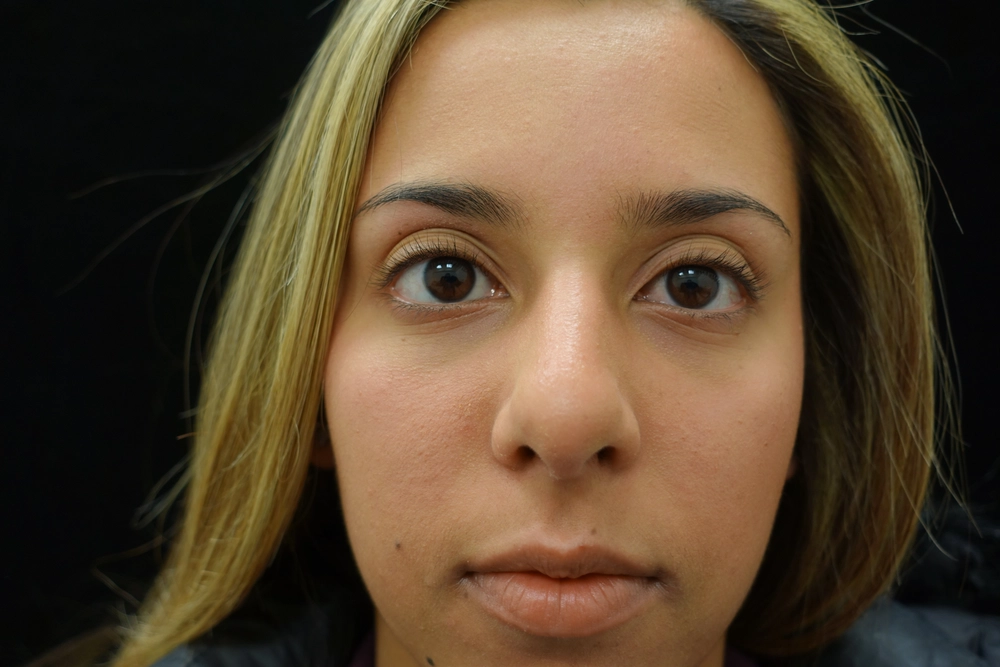 rhinoplasty After Photo for Patient #3