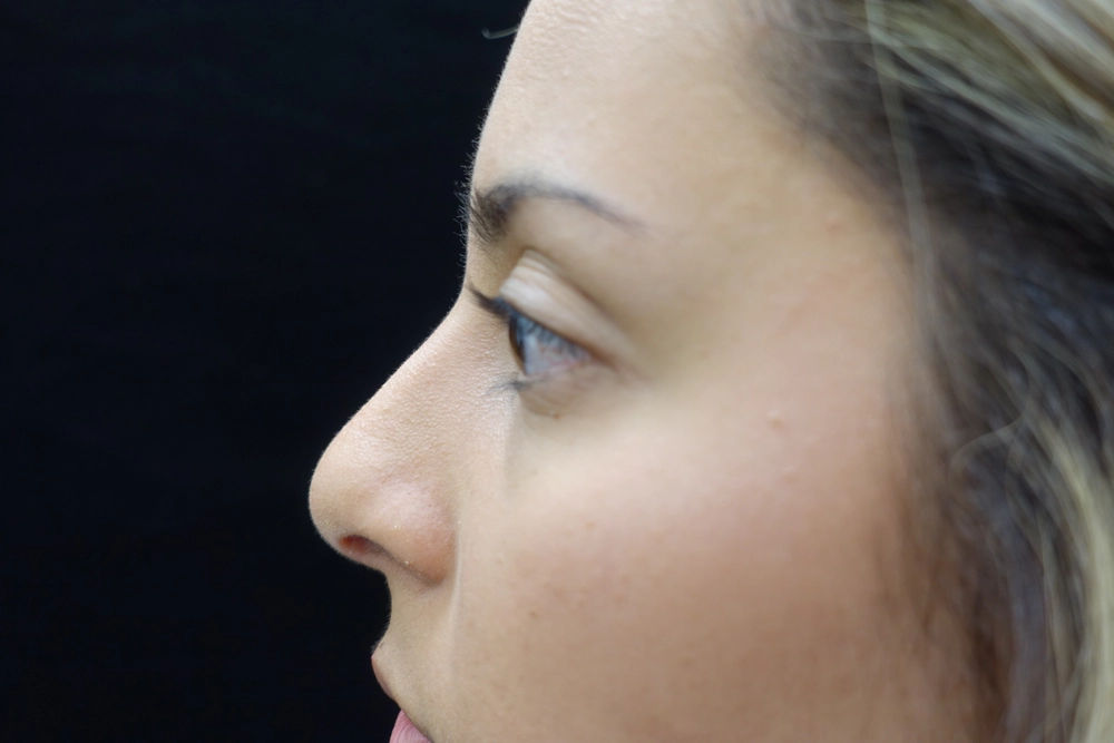 rhinoplasty After Photo for Patient #3