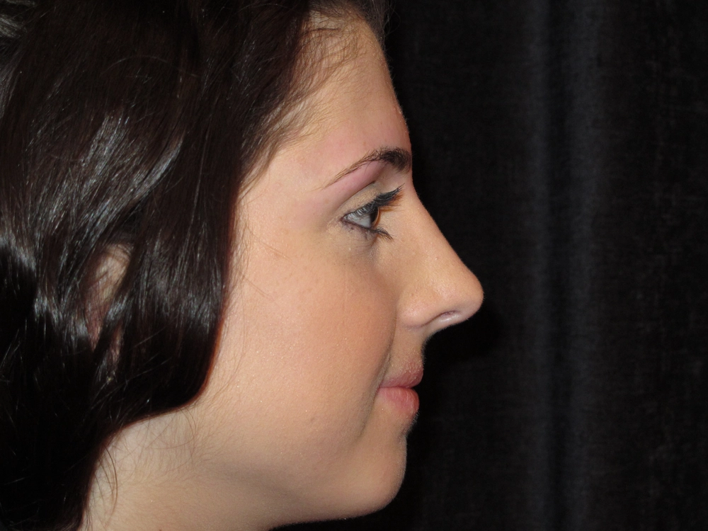rhinoplasty After Photo for Patient #4