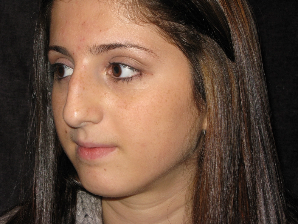 rhinoplasty Before Photo for Patient #4