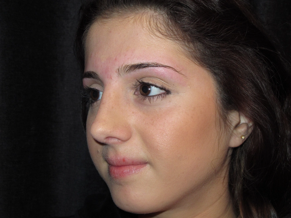 rhinoplasty After Photo for Patient #4