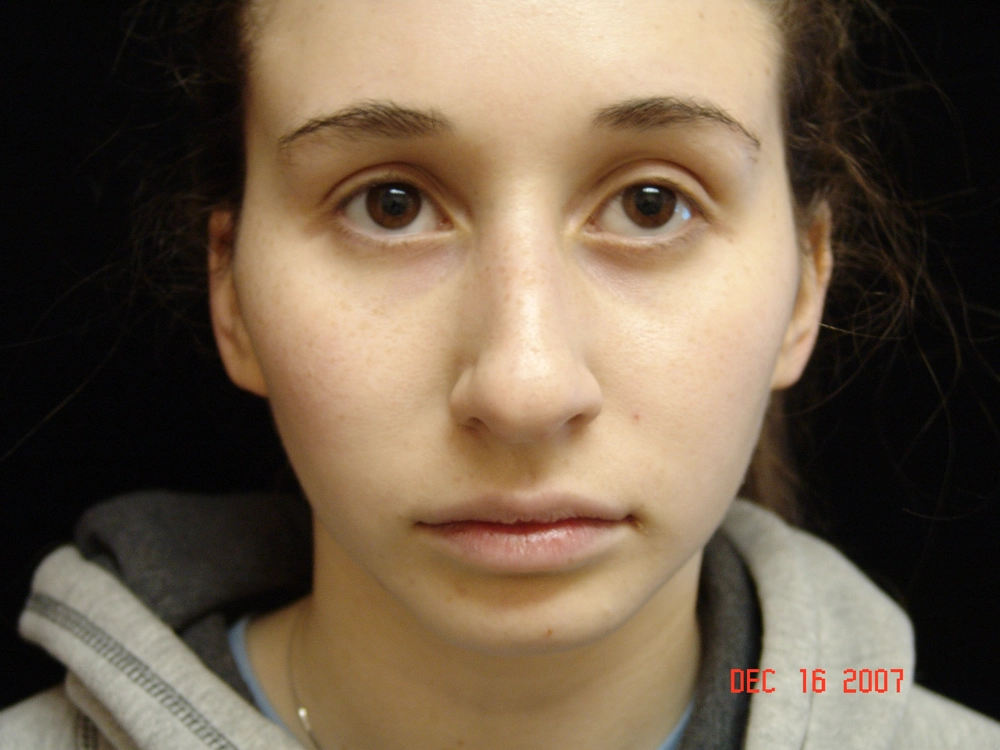 rhinoplasty Before Photo for Patient #5