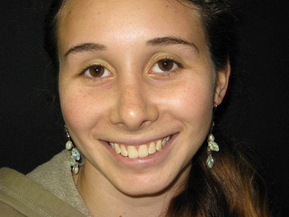 rhinoplasty After Photo for Patient #5