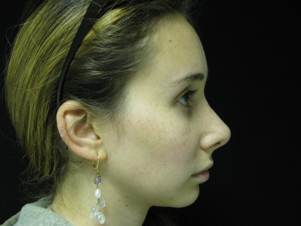 rhinoplasty After Photo for Patient #5