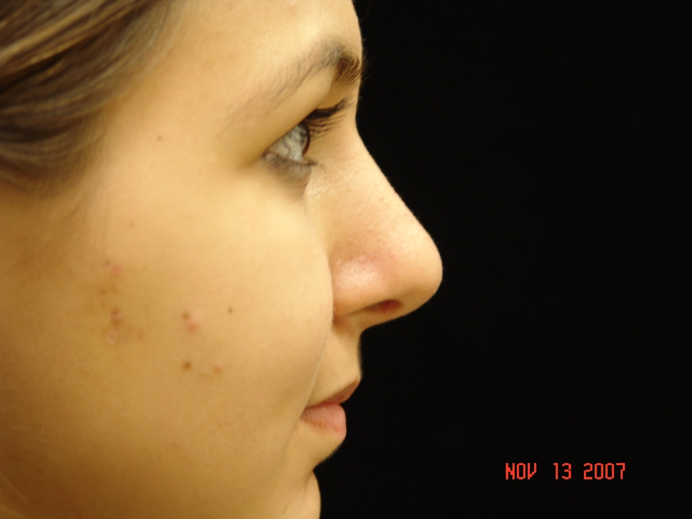 rhinoplasty After Photo for Patient #6