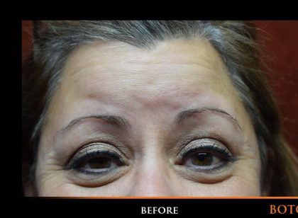 Botox Before & After Patient #1259
