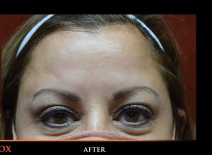 Botox Before & After Patient #1259