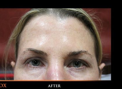 Botox Before & After Patient #1266