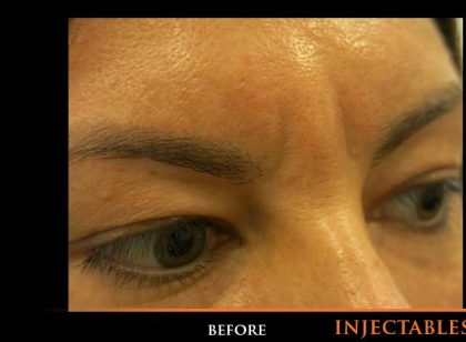 Injectable Glabella Before & After Patient #1250