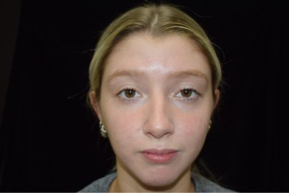 Rhinoplasty Before & After Patient #1201