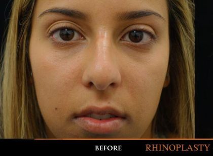Rhinoplasty Before & After Patient #1199