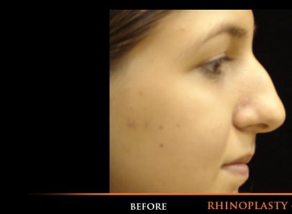 Rhinoplasty Before & After Patient #1195